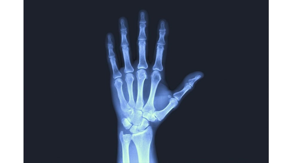 рентгенова снимка на длан